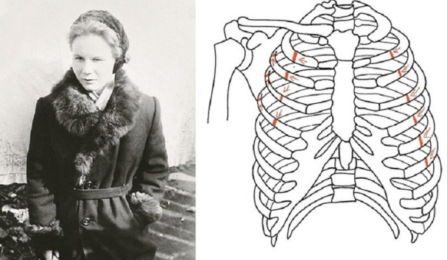 Lyudmila Dubinina fractured ribs Lyudmila Dubinina fractured ribs