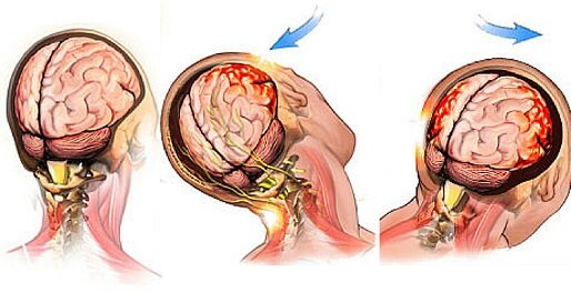 Traumatic brain injury Traumatic brain injury