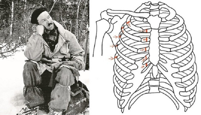 Semyon Zolotaryov fractured ribs Semyon Zolotaryov fractured ribs